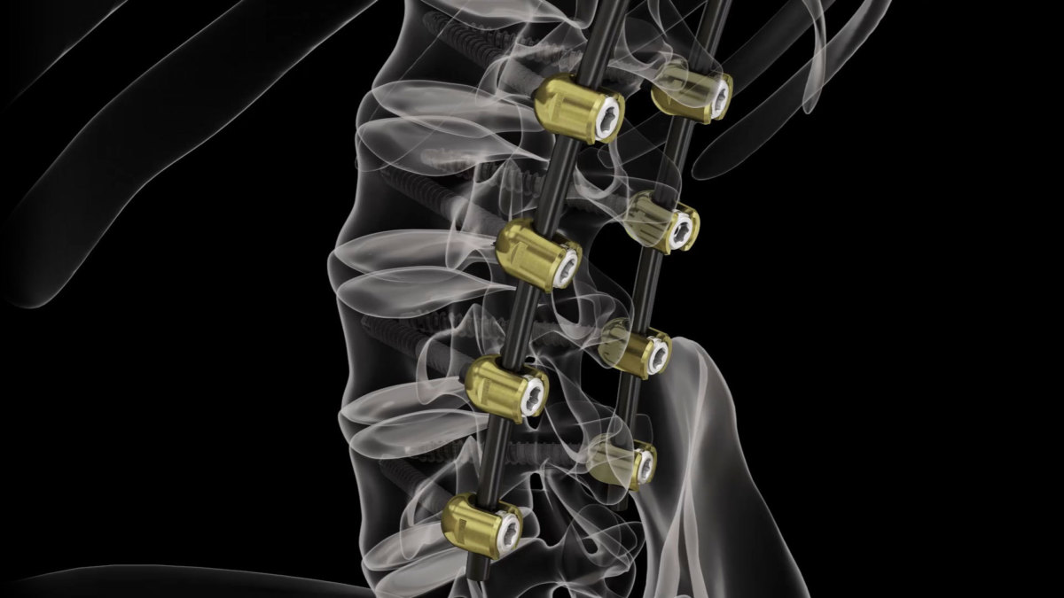 Icotec erhält Zulassung für Implantatsystem